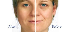 Microcurrent Facial before and after "The Turbo Lift"