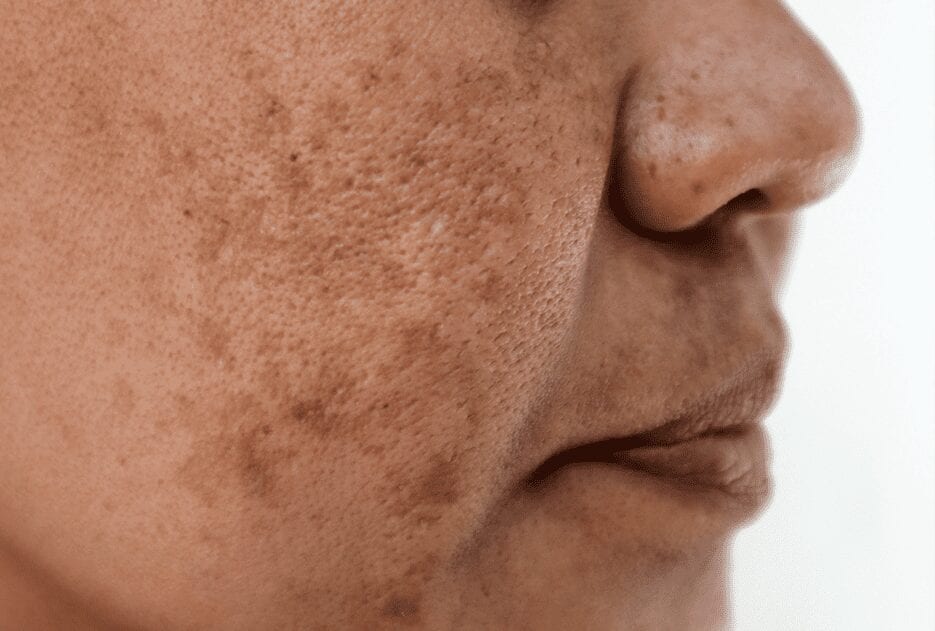 Melasma and Skin Discoloration: A Rising Epidemic