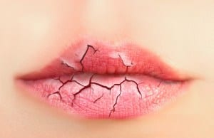 Chronic Chapped Lips:  Cause, Effect and Solutions