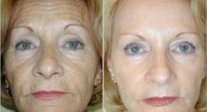 Daytona® Pure before and after a course of 4 treatments