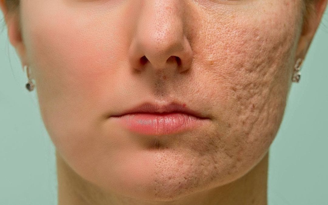How to Improve Your Skin Texture in Just One Week
