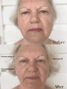 Linda Ramey Before and After Results from Sunshine Botanicals Double Cleanse Process