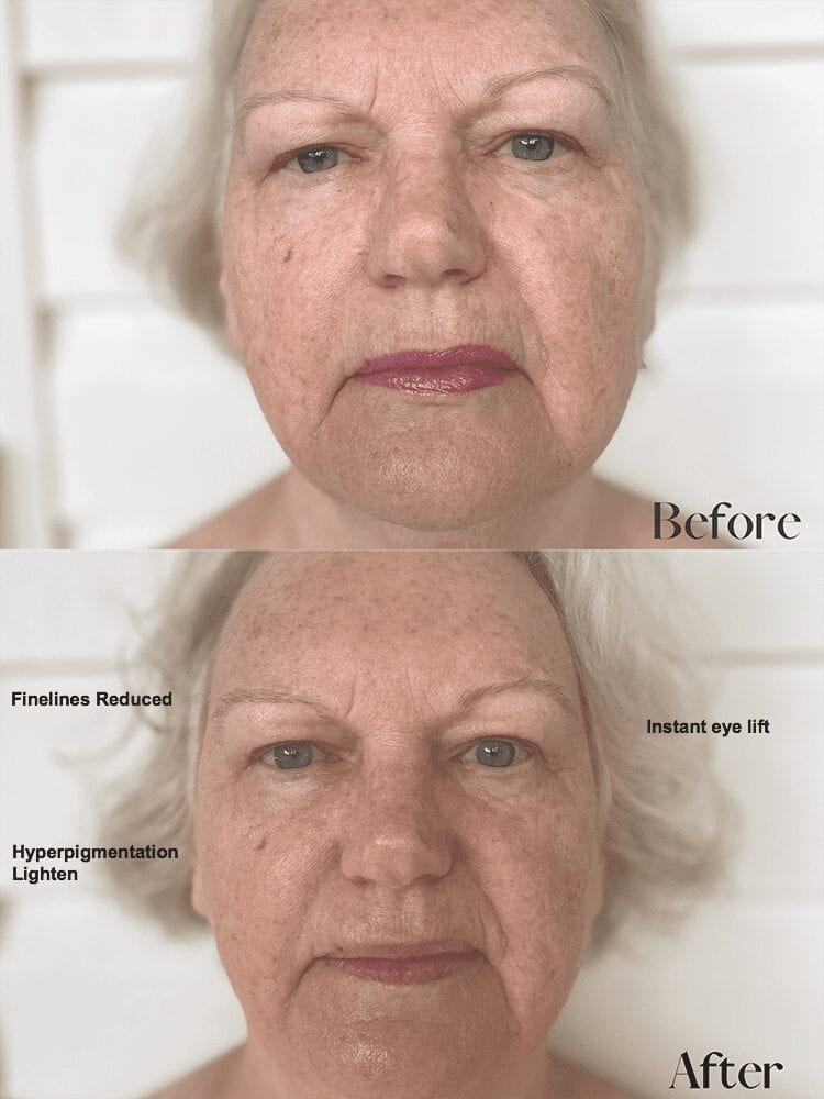 Linda Ramey Before and After Results from Sunshine Botanicals Double Cleanse Process