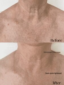 Linda Décolletage before and after