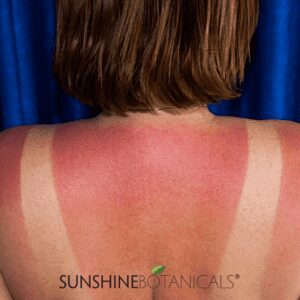 Sunburn I need relief -