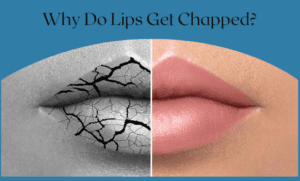 Why do lips get chapped, and should we be doing more than simply applying ChapStick?